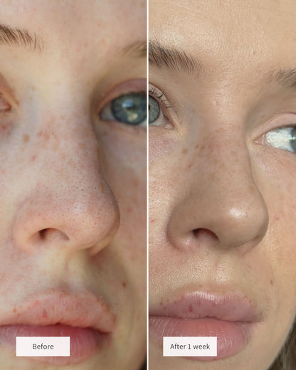 👃🫧 GarageLine® Hydrocolloid Nose Patches — Gentle Pore Cleansing & Oil Control ✨🍃