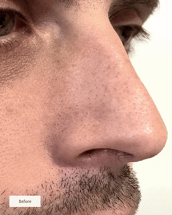 👃🫧 GarageLine® Hydrocolloid Nose Patches — Gentle Pore Cleansing & Oil Control ✨🍃